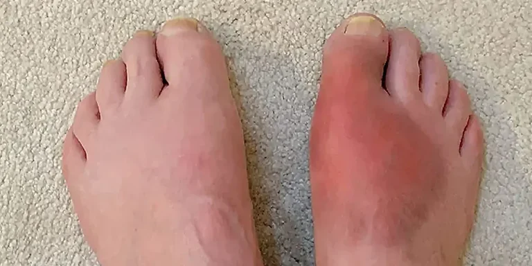 cara mengobati asam urat secara alami