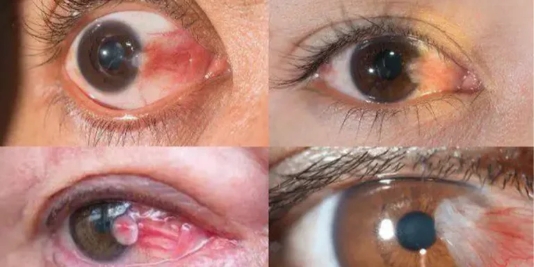 ilustrasi gambar lemak di mata pterigium