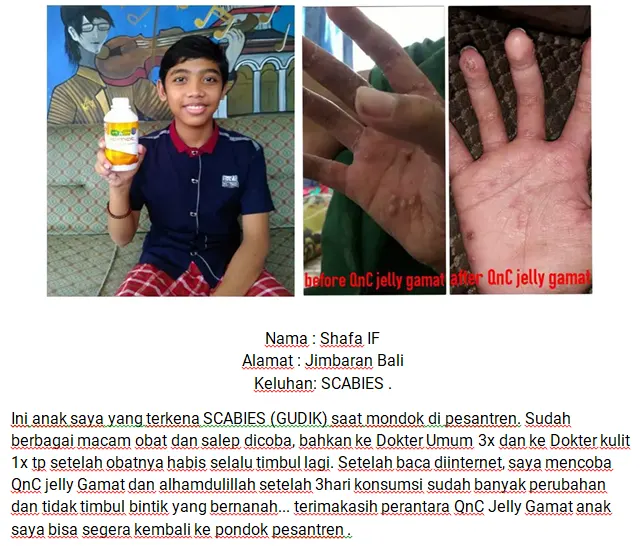 testimoni qnc jelly gamat untuk kudis