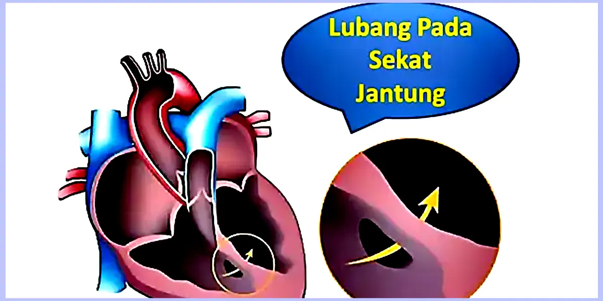 ciri-ciri jantung bocor pada anak dan dewasa
