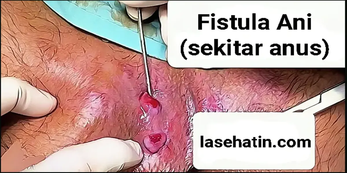 fistula ani dan gejala