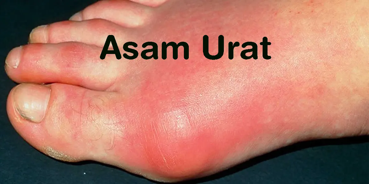 penyebab, pencegahan dan dampak asam urat