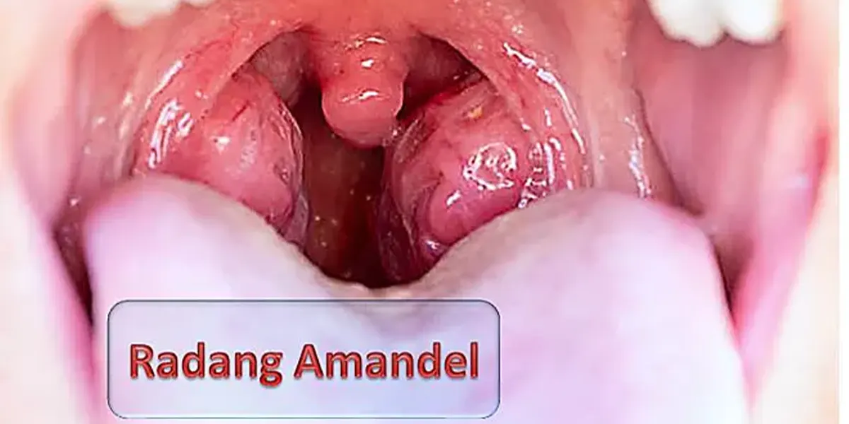 penyebab dan gejala amandel